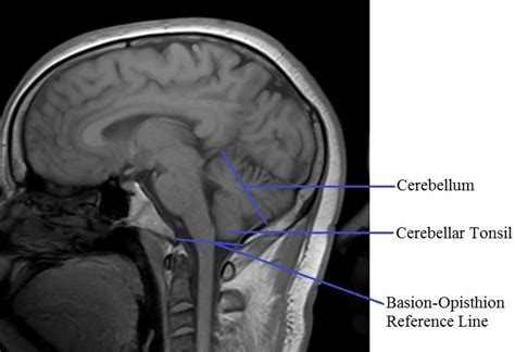 Cerebellar Peduncle Mri Anatomy