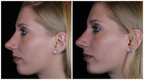 Reshaping your nose - without surgery! | Med Spa | Broomfield