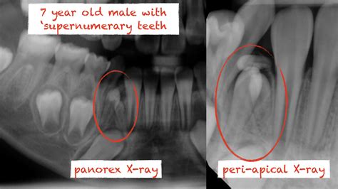 2. super numarary teeth odontoma extraction kazemi oral surgery | 2. super numarary teeth ...