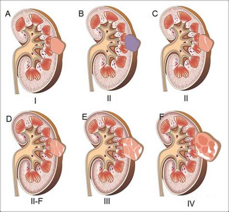 Kidney Cyst - Causes, Diagnosis, Symptoms, Complications & Treatment