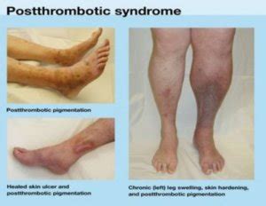 Post Thrombotic Syndrome - Symptoms, Treatment, Causes, Diagnosis