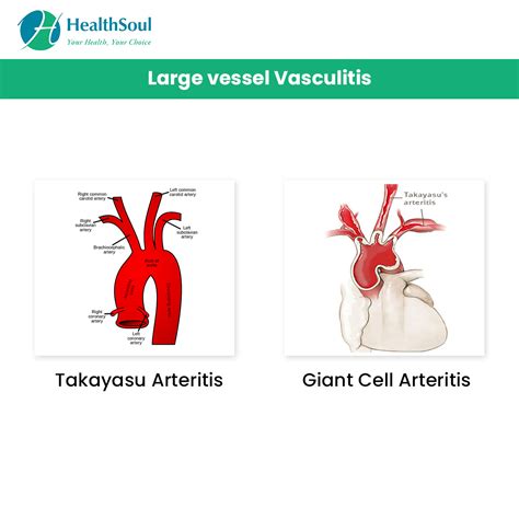 Vasculitis: Types, Symptoms and Treatment – Healthsoul