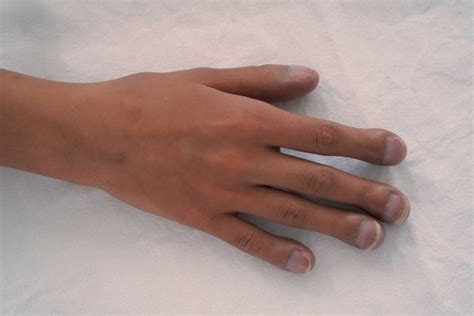 Clubbed Fingers as an Early Sign of Illness - Facty Health