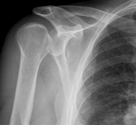 Posterior Shoulder Dislocation • LITFL • Trauma Library