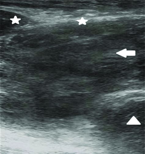 Ultrasound finding of a deep neck hematoma. * strap muscles; → ...