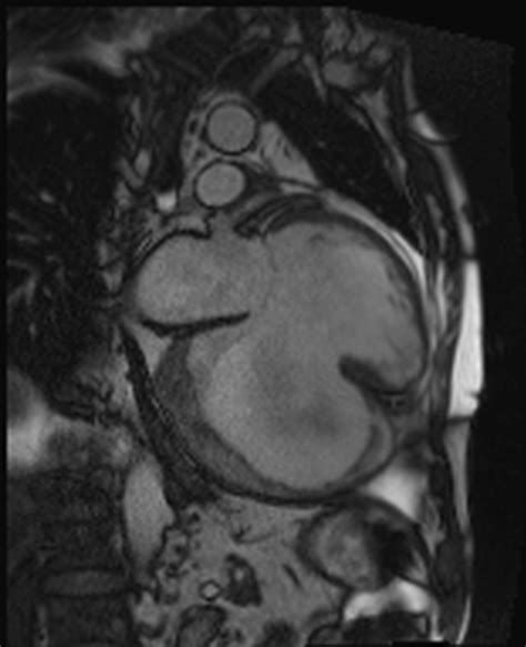 Repair of the giant left ventricular inferior wall aneurysm - Authorea