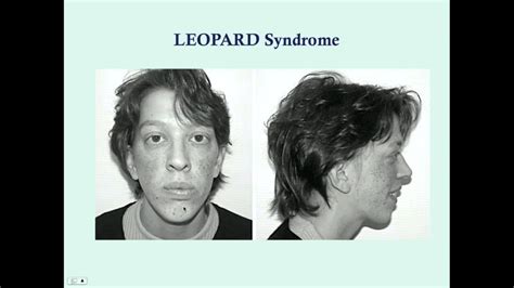 LEOPARD Syndrome - CRASH! Medical Review Series - YouTube