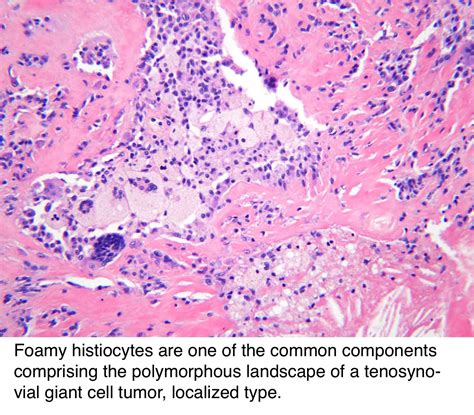 Pathology Outlines - Tenosynovial giant cell tumor, localized type