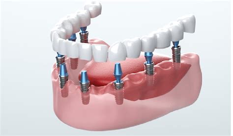 Dental Implants Can Help Restore Your Smile and Bite Function