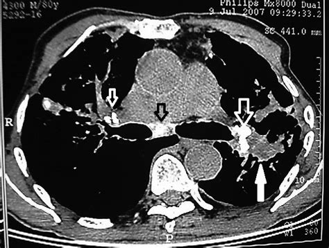 Hilar and carinal lymph node calcification (open arrow) and an ...