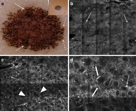 Images of a biopsy-diagnosed compound Clark (dysplastic) nevus, which ...