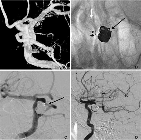 A. A large aneurysm with a fetal type posterior cerebral artery (PCA ...