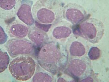 40x megaloblasts with eosinophils | Download Scientific Diagram