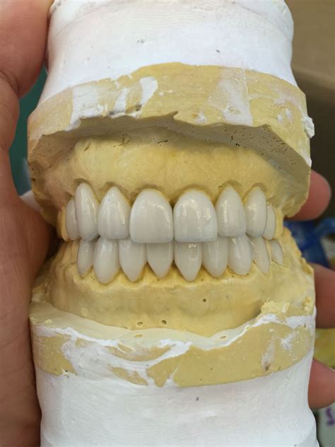 All porcelain emax veneers on the model before delivery Dentistry ...