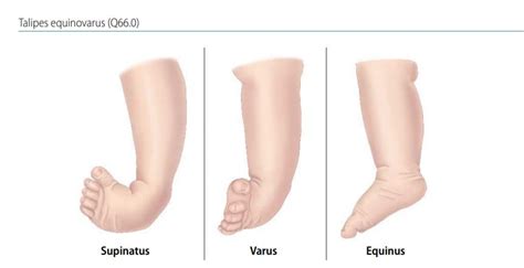 Varus club foot types 124441