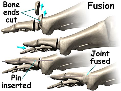 New Treatment For Hallux Rigidus - Captions Profile