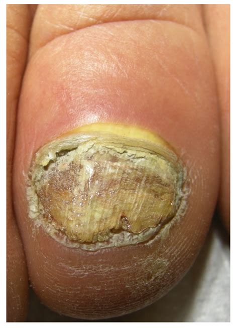 JoF | Free Full-Text | Onychomycosis: A Review | HTML