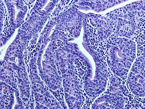 Uropatología en Línea: Carúncula Uretral Asociada a Uretritis Glandular ...