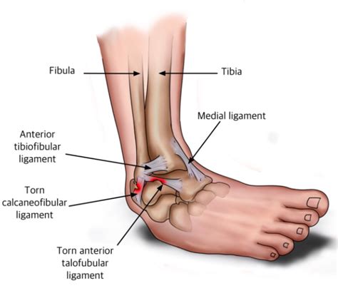 Ankle Sprain: Causes, Symptoms, and Diagnosis