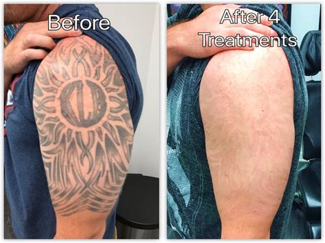 Alka Skin Laser Clinic | Laser Tattoo Removal Price in Nepal, Before and After, Side Effects