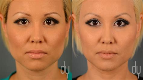 BOTOX BEFORE AND AFTER - Desmotsdart | image-blog