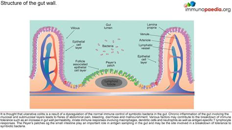 Pathophysiology Of Ulcerative Colitis