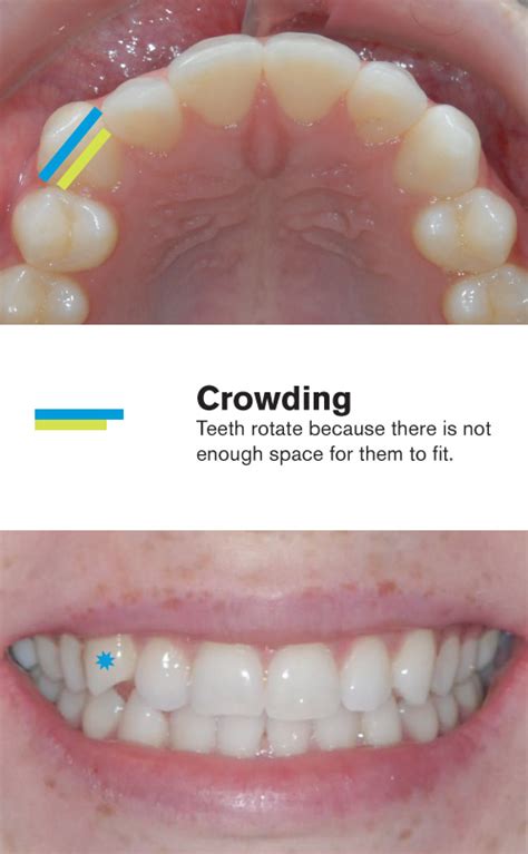 Before and After Invisalign Mild Crowding • Viechnicki Orthodontics