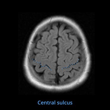 Central sulcus | Radiology Reference Article | Radiopaedia.org