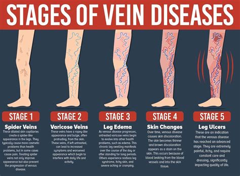 Understanding Venous Disease – Las Vegas Vein & Skin Clinic | Varicose ...