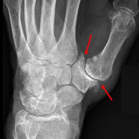 Thumb Arthritis - Raleigh Hand Surgery — Joseph J. Schreiber, MD