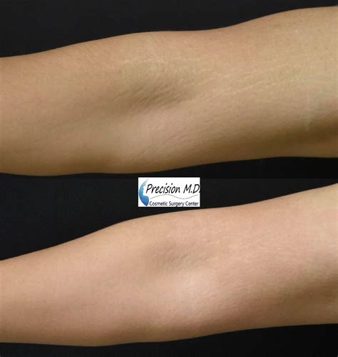 Laser Stretch Mark Removal Sacramento | Stretch Marks Treatment