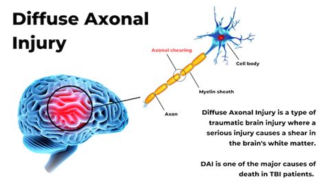 Brain Injury Lawyers | Diffuse Axonal Settlements and Lawsuits