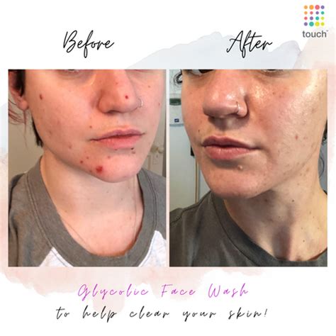 Glycolic Acid Before and After : Transformative Skincare – Touch Skin Care