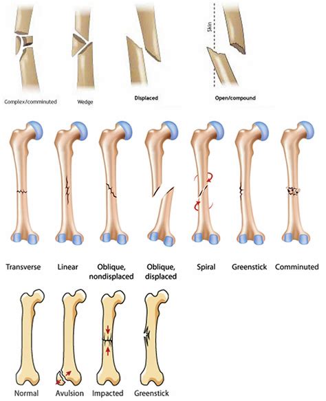 Broken femur types, causes, treatment, recovery time & complications