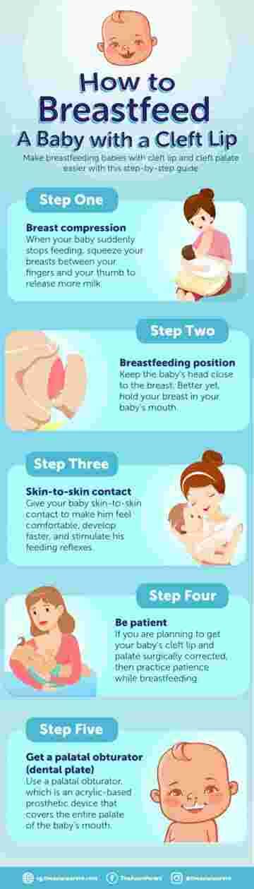 Cleft Lip And Palate Feeding Problems And How To Overcome Them