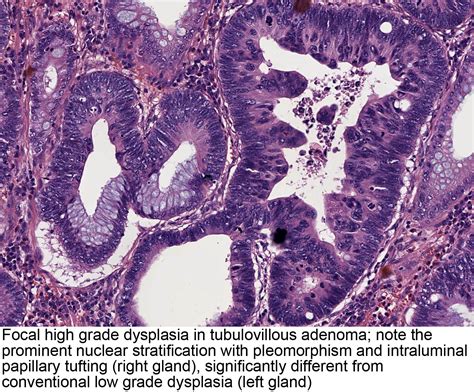 Pathology Outlines - Tubulovillous / villous adenoma