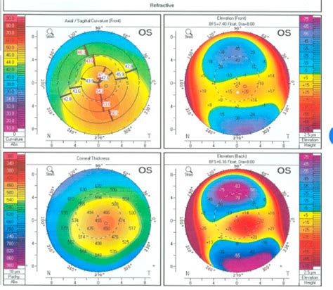 How Do I Correct Regular and Irregular Astigmatism? | Manhattan Eye