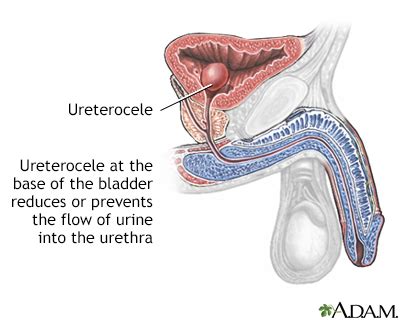 Ureterocele Symptoms, Doctors, Treatments, Advances & More | MediFind