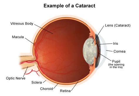 Cataracts in Children