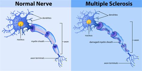 Defining Multiple Sclerosis: What’s the Role of Myelin, Immune-mediated Disease And T-Cells ...