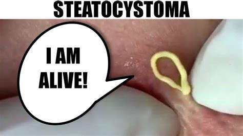 Steatocystoma! Dr. Sandra Lee vs Neck Cysts - YouTube