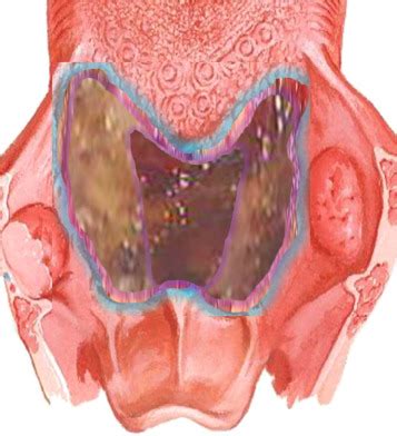 Transoral robotic partial glossectomy and supraglottoplasty for obstructive sleep apnea ...