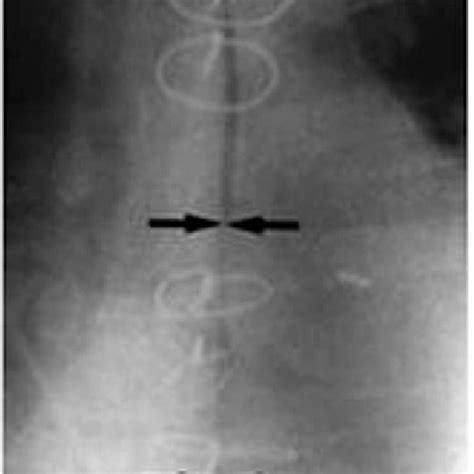 (PDF) Figure-of-Eight vs. Interrupted Sternal Wire Closure of Median ...