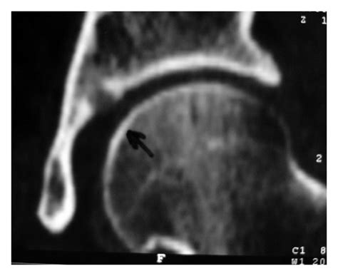 MR arthrogram of the right hip showing a lesion located at the base of ...