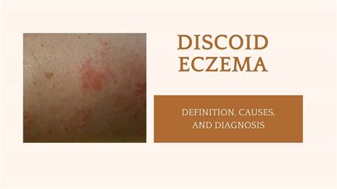 What Is Discoid Eczema: Symptoms, Causes, And Diagnosis