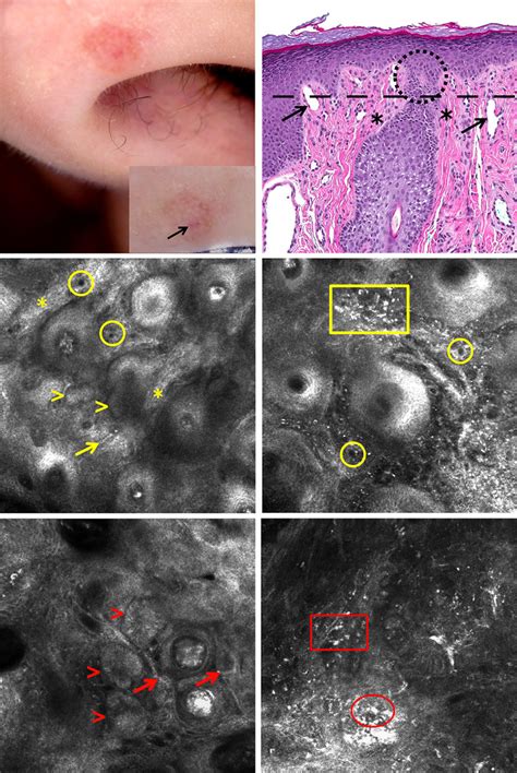 Nasopharyngeal Angiofibroma Histology