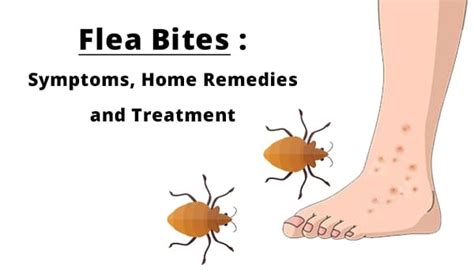 Flea Bites : Symptoms, Home remedies and Treatment