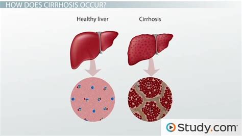 Cirrhosis: Definition, Causes & Treatments - Lesson | Study.com