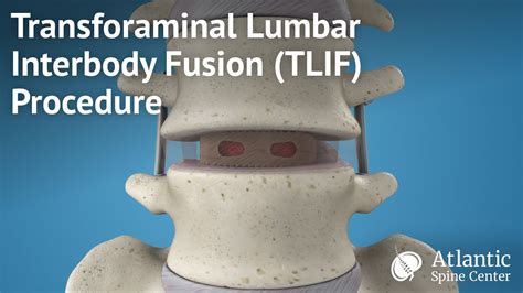 Mini TLIF Procedure Overview - cooling tips