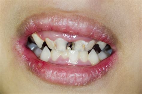 Broken teeth stock photo. Image of children, child, caucasian - 80069392